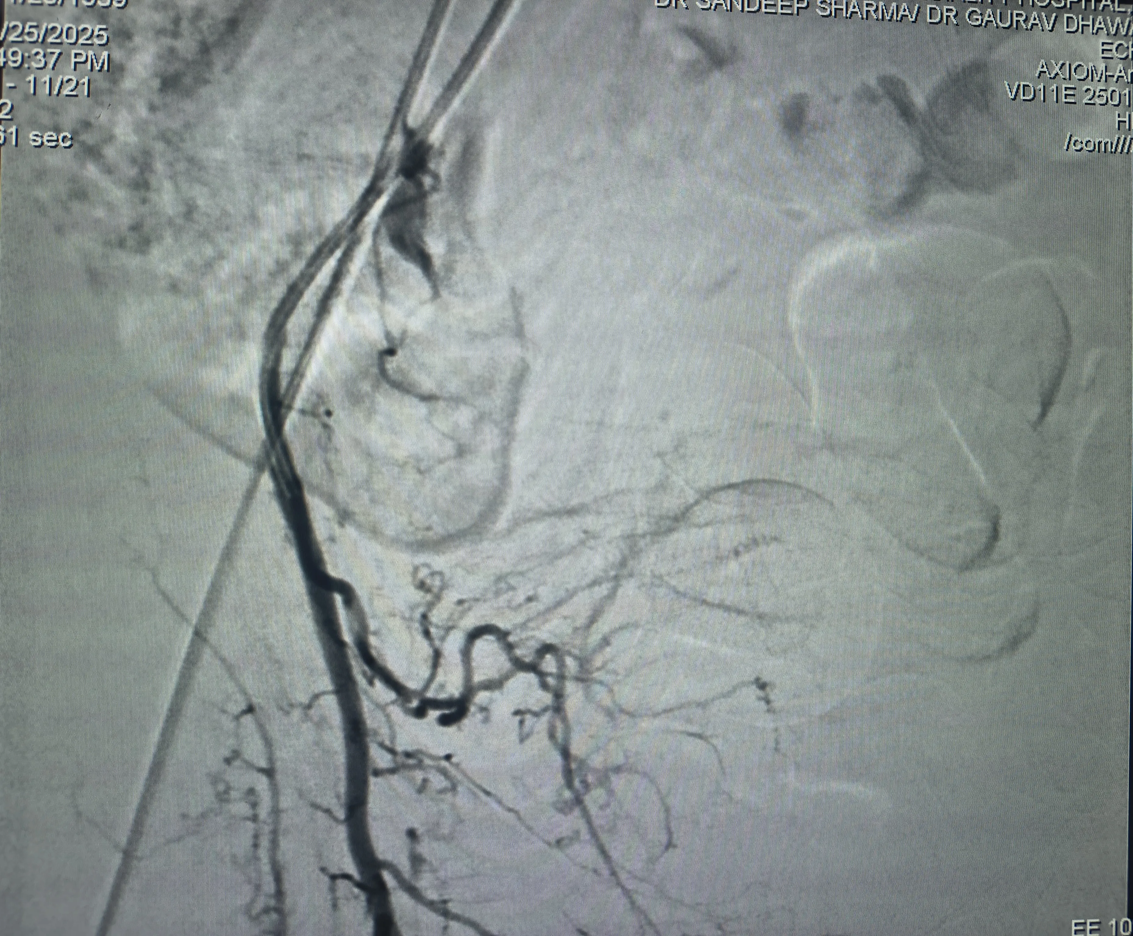 Right Prostatic Artery arising from the Obturator Artery